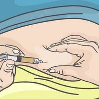 subdermal by sputnik_1