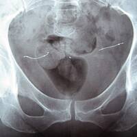 Essure, des femmes cobayes en errance médicale par Jet FM et Splann ! by Splann ! Enquêtes