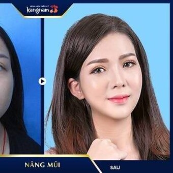 N&acirc;ng mũi thẩm mỹ